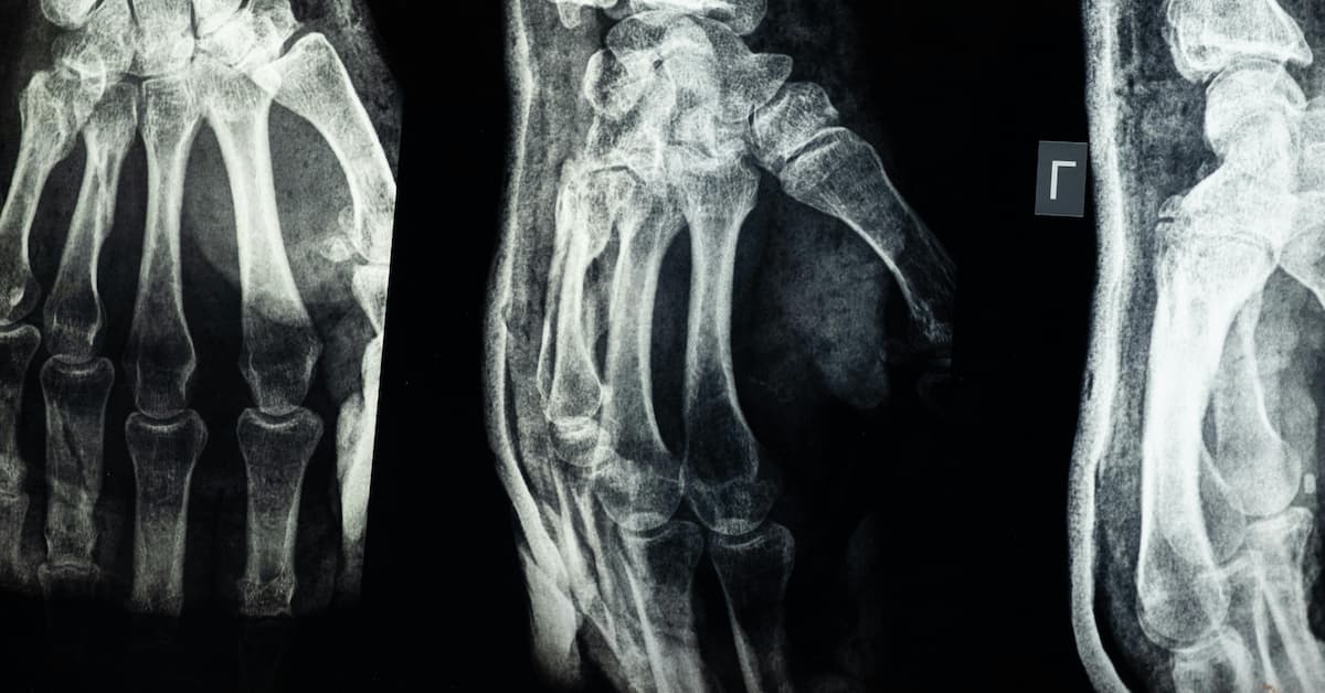 hand & finger fracture diagnosis boise